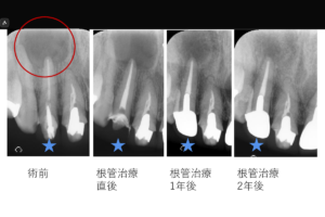 【約15mmの根尖病変を非外科的根管治療で治癒した症例】「歯茎を押すと痛い、他院で抜歯と言われた。」