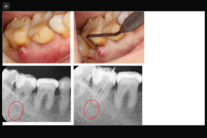 【二重に彎曲した樋状根の症例】「歯茎を押すと膿が出て痛い、他院で歯周病の治療を約1年続けていたが腫れが引かない。」