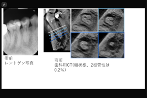 【根尖部外部吸収を伴う2根管性下顎第二小臼歯の症例】「近医で根管治療するも咬むと痛い。」