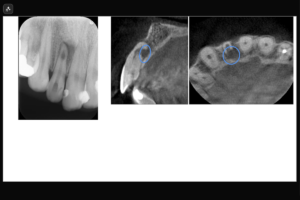 【根尖内部吸収および穿孔を伴う上顎右測側切歯の症例】「近医より紹介、咬むと痛い。」