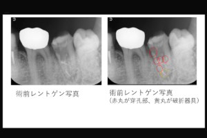 【5ヵ所の穿孔と根尖部の破折器具を伴う下顎左側第二大臼歯の症例】「近医で抜歯と言われたが、歯を残したい。」