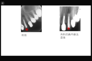 【補綴的理由で外科的歯内療法を希望された上顎左側中切歯の症例】「歯茎を押すと痛い。」