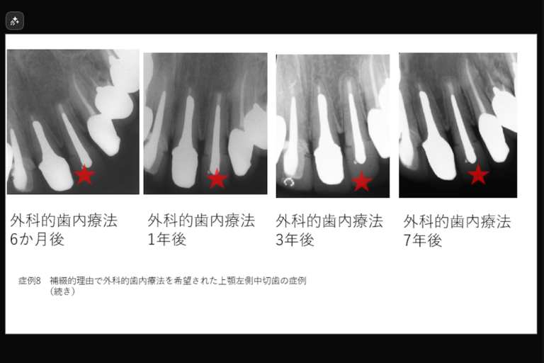 【補綴的理由で外科的歯内療法を希望された上顎左側中切歯の症例】「歯茎を押すと痛い。」 - 東京の歯内療法専門「渡辺歯内デンタルオフィス品川 ...